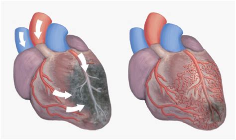 Alt="illustration Of Two Hearts, One Showing Ischemia - Eecp Effects On Heart, HD Png Download ...