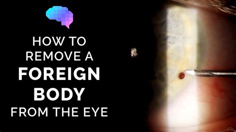 How to Remove a Foreign Body from the Eye | Eye Injury | OSCE Guide ...