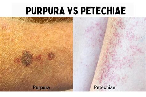 Petechiae Rash Pictures Causes Images Treatment