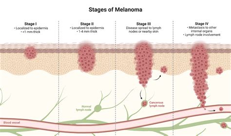 Melanoma Staging | BioRender Science Templates