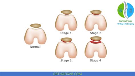 Patellofemoral Pain Syndrome And Chondromalacia Patella –, 42% OFF