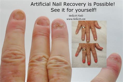 Bella10 Nails: The Secret to Artificial Nail Recovery