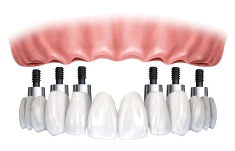 TIPOS DE PRÓTESIS SOBRE IMPLANTES – Blog Cervera Dental