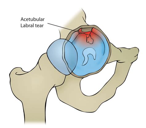 Hip Labral Tear - Motus Physical Therapy