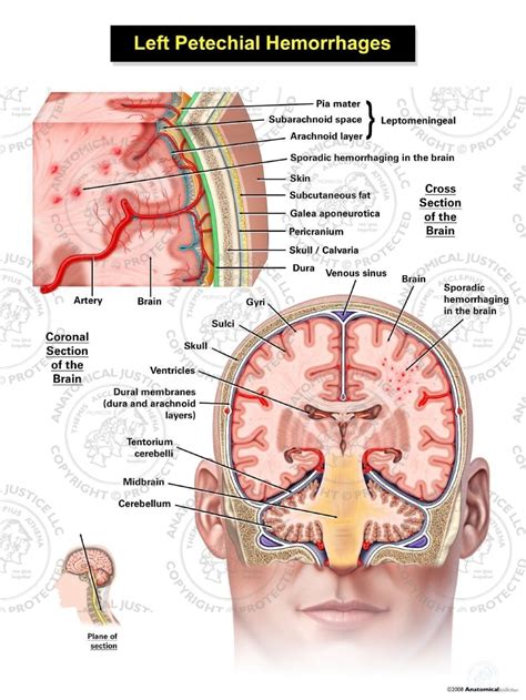 Left Petechial Hemorrhages