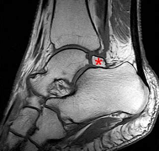 MRI Musculo-Skeletal Section: Posterior ankle impingement.