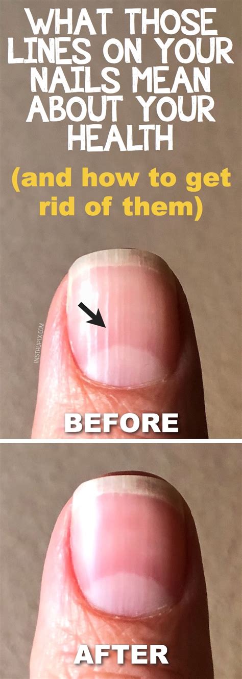 What Those Vertical Lines On Your Nails Mean About Your Health