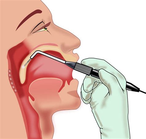 Sleep Apnea Pillar Procedure