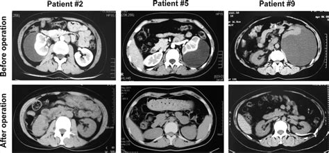 CT scan images before and after retroperitoneal laparoscopic renal ...