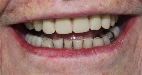 Partial Dentures (plates) - Northland Prosthodontics - Northland Denture Specialist - Whangarei