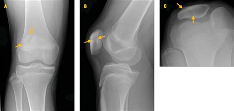 Bipartite Patella in a Young Athlete | Journal of Orthopaedic & Sports Physical Therapy