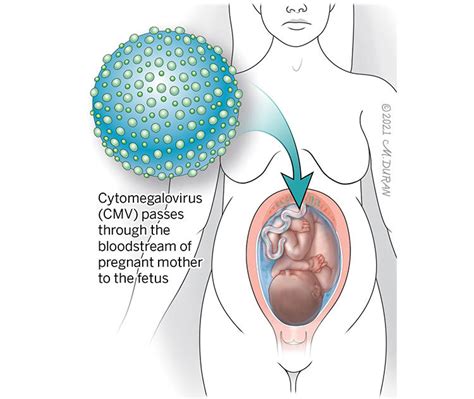 Partners in Care | Cytomegalovirus (CMV) is treated in the…