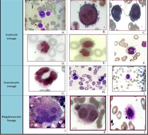 Diagnosis and Classification of Myelodysplastic Syndrome | IntechOpen