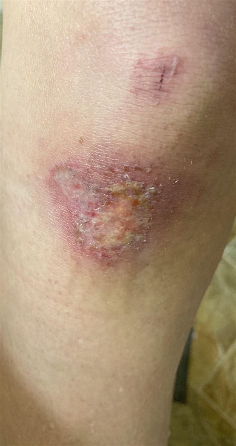 Scraped Knee - Does this look OK? : r/firstaid