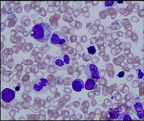 Clinical Presentation, Diagnosis, and Prognosis of Myelodysplastic Syndromes - The American ...