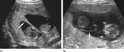 , 28. (27) Dichorionic diamniotic twins at 13 weeks gestation. Axial ...