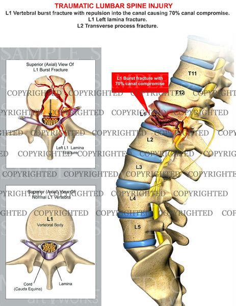 Traumatic L1 Burst fracture with canal compromise — Medical Art Works