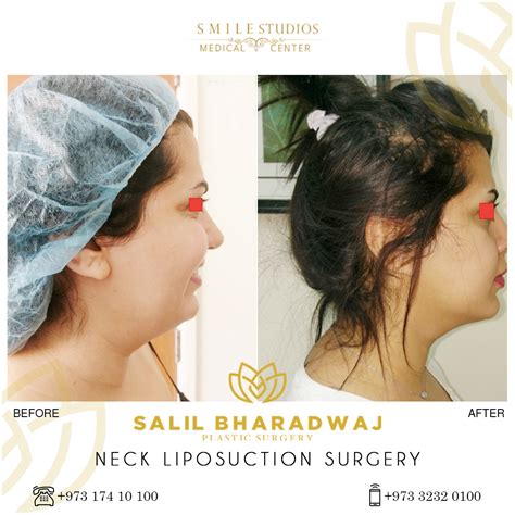 Liposuction Gallery - Smile Studios - Best Medical Center in Bahrain & GCC