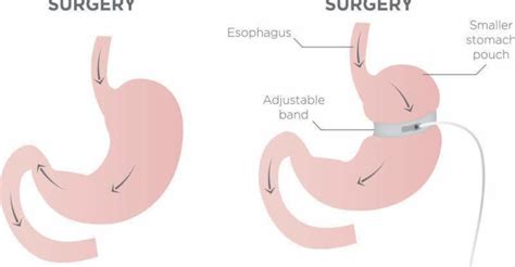 Gastric Band Surgery - Common Medical Tourism Procedures - Medical Tourism Guide, Magazine ...