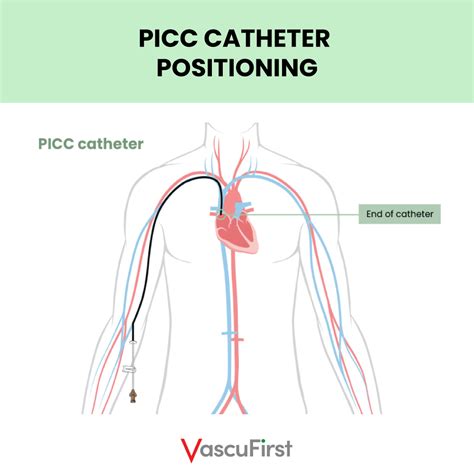 Peripherally inserted central catheters (PICCs): The key principles - VascuFirst