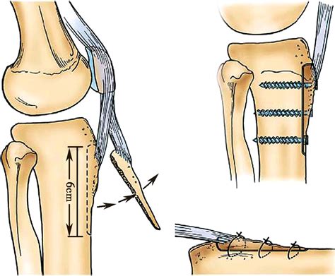 TKA: First Total Knee Replacement Surgery - Medical News