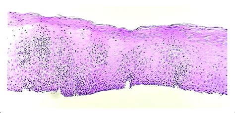 Proximal esophagus biopsy shows squamous mucosa with mild chronic... | Download Scientific Diagram