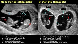 Fetal Bladder Ultrasound Normal Vs Abnormal Images | Ge... | Doovi