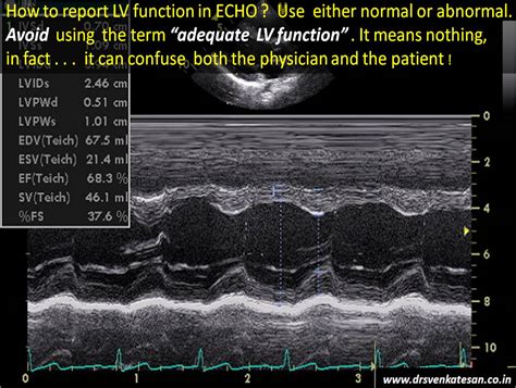 LV ejection fraction | Dr.S.Venkatesan MD