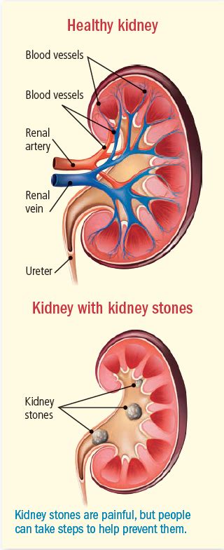 Kidney Stone Pain Location