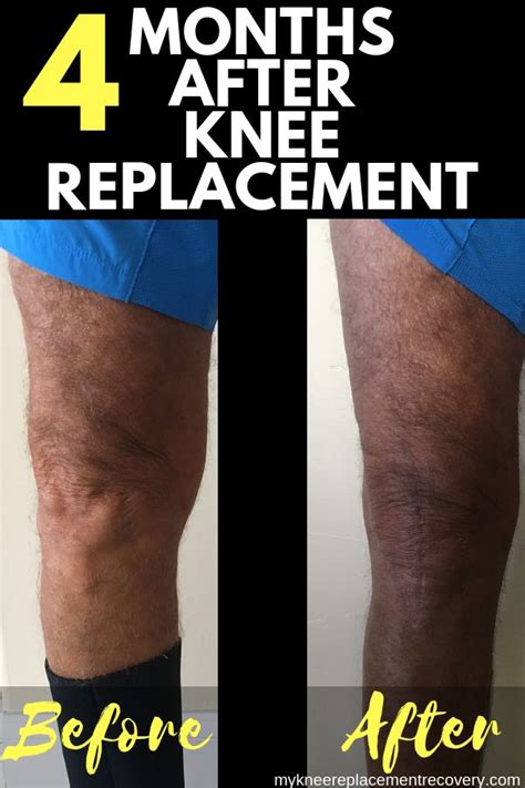 Pin on MyKneeReplacementRecovery.com