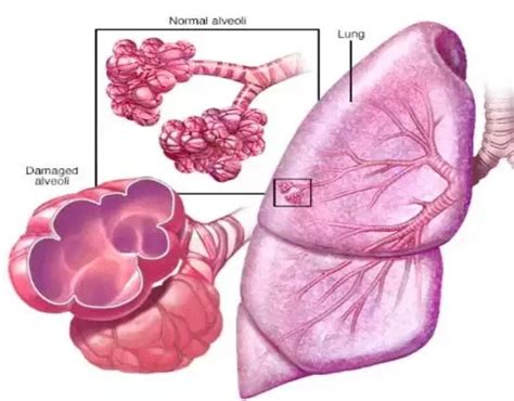 Dr. Parthiv Shah’s COPD Exacerbation Prevention: 10 Key Strategies | by ...