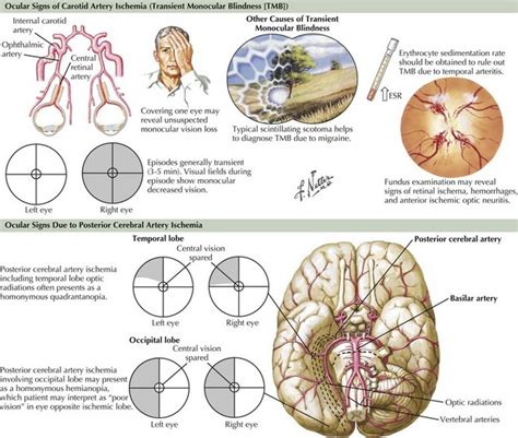 Ischemic Stroke | Neupsy Key