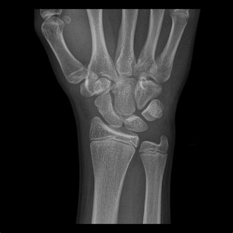 Carpal Bone Fracture