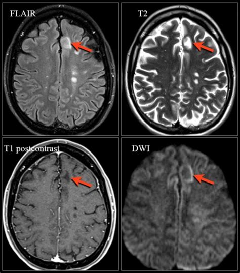 Ms Mri Brain Scan Results