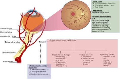 Central Retinal Artery Occlusion: A Review of Pathophysiological ...