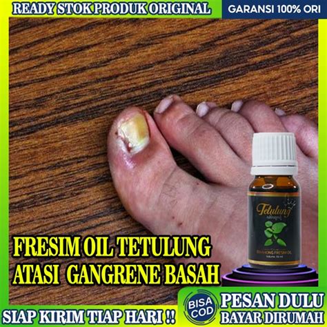 Jual Obat Cantengan Kuku Jempol Kaki, Fresim Oil Obat Gangrene Basah,Obat Pengering Luka ...