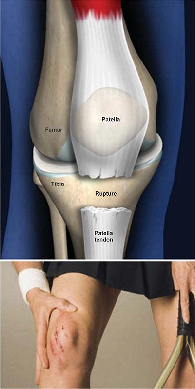 Patella Tendon Rupture | Central Coast Orthopedic Medical Group