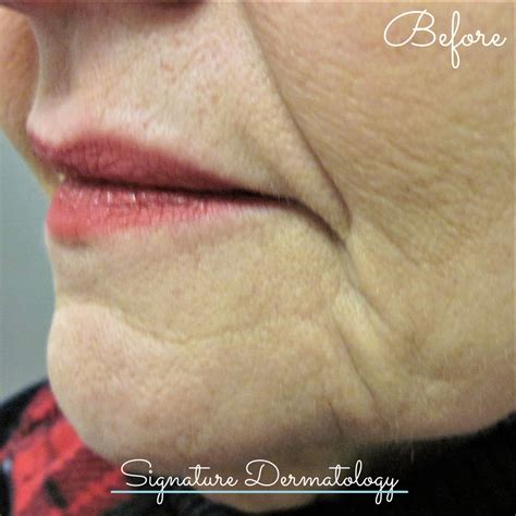 Marionette Lines Before and After | Signature Dermatology