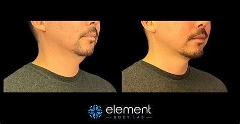 COOLSCULPTING FOR MEN IN DALLAS : ELEMENT BODY LAB