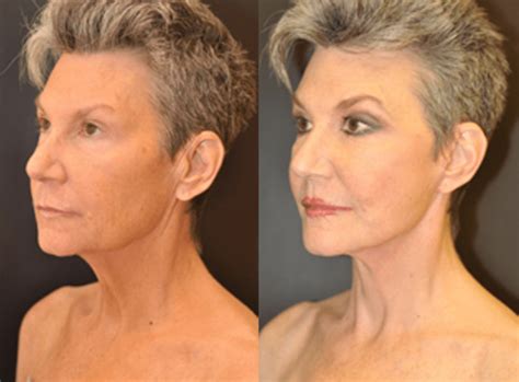 Mini Facelift | Dr. Dean Kane | Baltimore Maryland