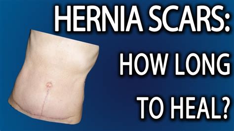 Stomach Hernia Surgery