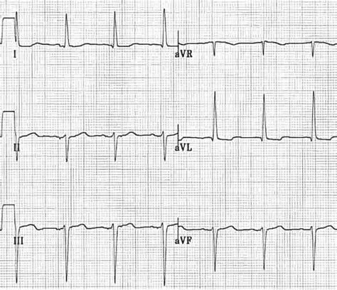 Left Anterior Fascicular Block (LAFB) • LITFL • ECG Library Diagnosis