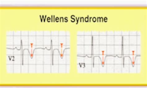 Wellens Syndrome Symptoms