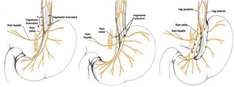 Vagotomie; vagotomies