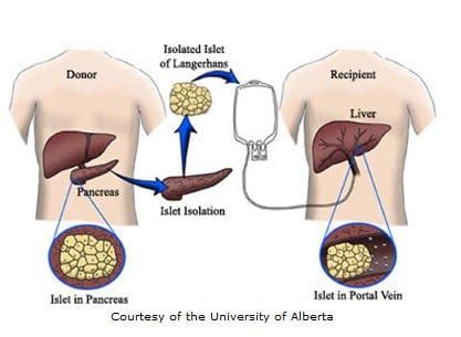 New Information on Islet Cell Transplantation - Diabetic Live