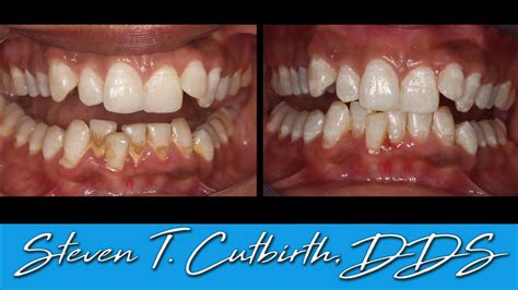 Scaling and Root Planing - Dental Minute with Steven T. Cutbirth, DDS - YouTube