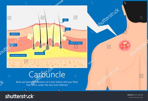 Carbuncle Boils Bacterial Infection Under Skin Stock Vector (Royalty ...