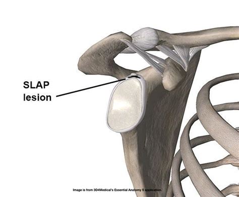 Understanding SLAP Lesions of the Shoulder and the Role of Physical ...