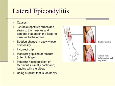 Lateral Epicondylitis