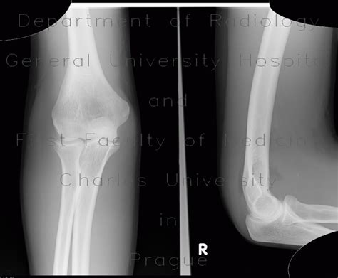 Radiology case: Effusion in elbow joint, sail sign, fracture of head of ...